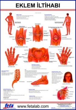 EKLEM İLTİHABI LEVHASI