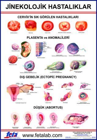 Jinekolojik Hastalıklar Eğitim Plakası
